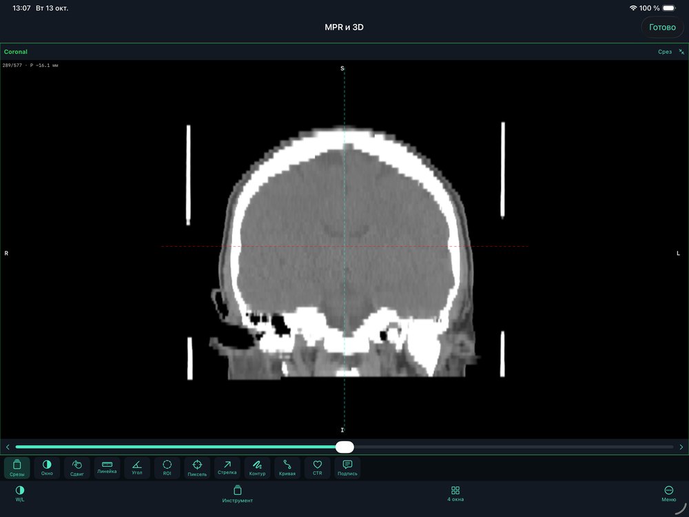 Coronal plane on its own